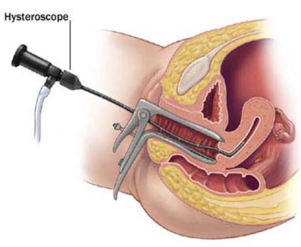 Diagnosticare hysteroscopie