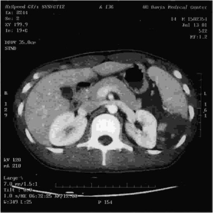 Diagnosticul leziunilor splinei