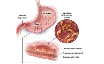 Dieta în caz de ulcer gastric și duodenal în perioada de exacerbare, meniu pentru fiecare zi