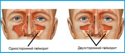 Kétoldalas arcüreggyulladás típusok, okai, tünetei, diagnózis, kezelés és a megelőzés a