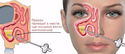 Kétoldalas arcüreggyulladás típusok, okai, tünetei, diagnózis, kezelés és a megelőzés a