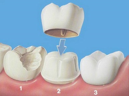 Egyszerű dentaire - fogászati ​​kezelés pulyka, amelyben koronák, implantátumok, fogászati ​​protézisek