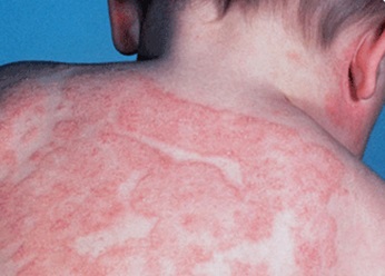 Eczema provoacă apariția non-corp la adulți, cauzele eczemei ​​pe spatele unui copil