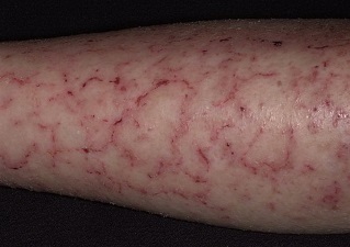 Eczema provoacă apariția non-corp la adulți, cauzele eczemei ​​pe spatele unui copil