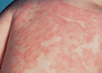 Eczema provoacă apariția non-corp la adulți, cauzele eczemei ​​pe spatele unui copil