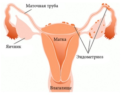 Simptome de endometrioză, tratament - ginecologie - enciclopedie medicală