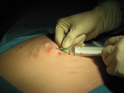 Metode de transfuzie și tratament feto-fetal