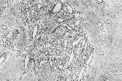 Fibroza și fibrosarcomul - tumori mezenchimale - erori și dificultăți de diagnostic histologic