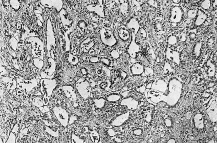 Fibróma és fibrosarcoma - mesenchymalis tumor - a hibák és nehézségek szövettani diagnózis