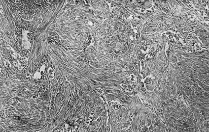 Fibroza și fibrosarcomul - tumori mezenchimale - erori și dificultăți de diagnostic histologic