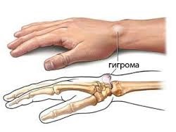 Fibromul pielii, îndepărtarea lipomului, îndepărtarea wenului