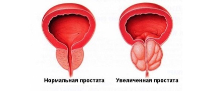 Fitolizina în prostatită - caracteristici ale administrării medicamentului