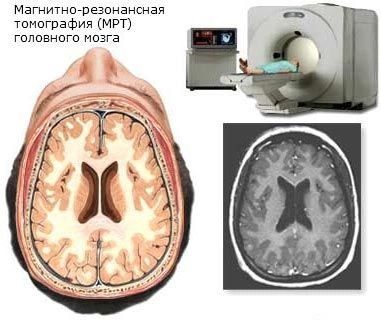 Amennyiben az MRI (mágneses rezonancia) az agy számítógépes diagnosztika