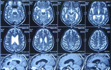 Amennyiben az MRI (mágneses rezonancia) az agy számítógépes diagnosztika