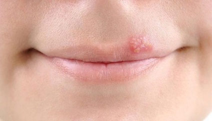 Herpesul provoacă fețele și simptomele