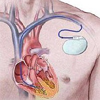 Pacemaker implantáció (ex) - árak Moszkva talált 156 árak