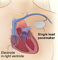 Implantarea stimulatorului cardiac, clinica de cardiochirurgie nordcardio