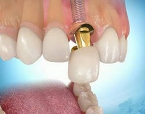 Implantarea dinților anteriori - indicații, tipuri de prețuri în St. Petersburg