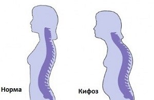 Cum se masteaza cu kyfoza coloanei vertebrale toracice