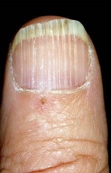 Ce cauze și simptome au boli fungice și non-fungice ale unghiilor pe picioare și mâini