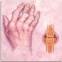 Cum să determinați simptomele artritei reumatoide, dureri articulare