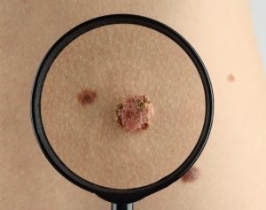 Hogyan lehet megelőzni a melanoma, Manor Medical Center, modul diagnózis és kezelés Izraelben