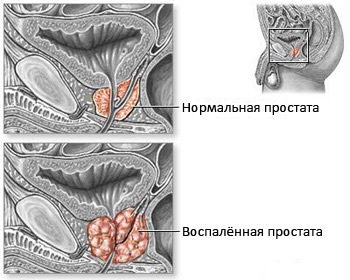 Prostatita calcică - trăsături, simptome, tratament, prevenire