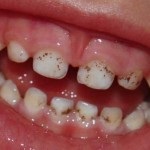 Cyst dentara de tratament la remediile populare acasă