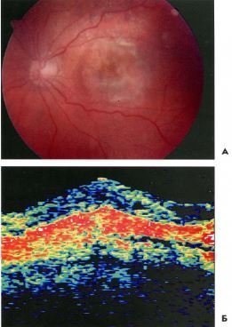 Clinica optică de coerență optică degenerare maculară senilă