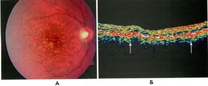 Clinica optică de coerență optică degenerare maculară senilă