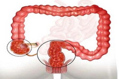 Colită de simptome intestinale, tratament la adulți, nutriție