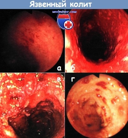 Kolonoszkópia colitis ulcerosa
