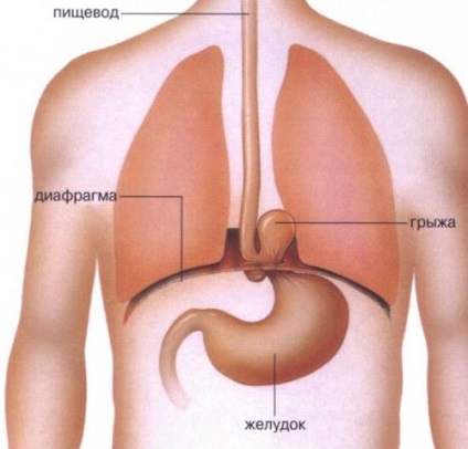 Cui în gât după masă provoacă senzații de bulgări, diagnostic