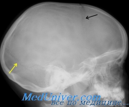 Semne și diagnostice pentru craniostenoză