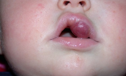 Punctul roșu de pe buză cauzează apariția și modalitățile de tratament