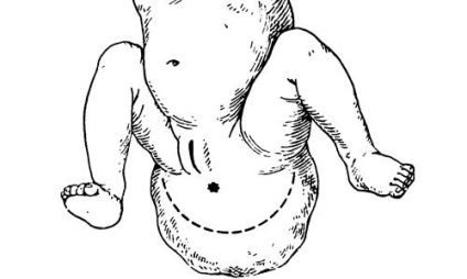 Teratomul sacral-coccygeal