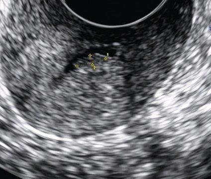 Cu privire la problema diagnosticului cu ultrasunete a polipilor endometriali și a canalului cervical