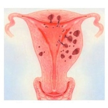 adenomyosis kezelés agyag