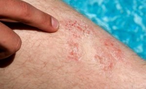 Psoriasis kezelése népi jogorvoslati receptek és módszerek