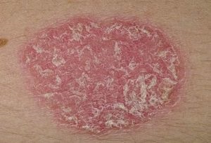 Psoriasis kezelése népi jogorvoslati receptek és módszerek