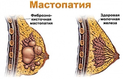 Mamoplastia cu mastopatie pot face cu forme fibrochistice, chistice, difuze