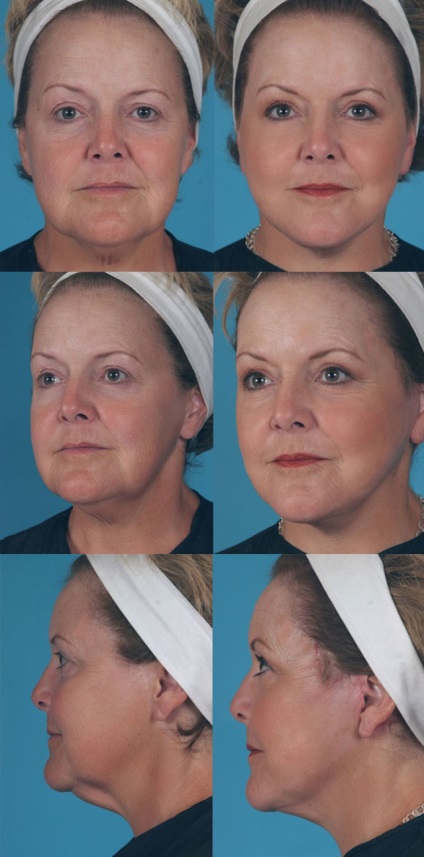 Minilifcarea feței - care este diferența față de ridicarea tradițională
