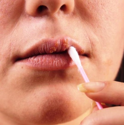 Este posibilă vindecarea rapidă a herpesului pe buzele unui remediu anti-herpes
