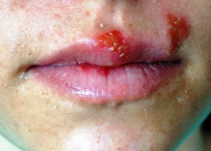 Este posibilă vindecarea rapidă a herpesului pe buzele unui remediu anti-herpes