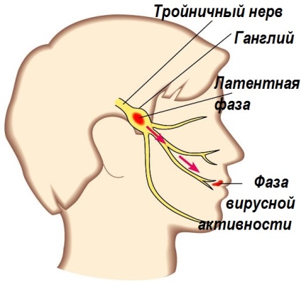 Este posibilă vindecarea rapidă a herpesului pe buzele unui remediu anti-herpes