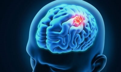 Stimularea magnetică directă a creierului ajută 84% dintre pacienții afectați de accident vascular cerebral