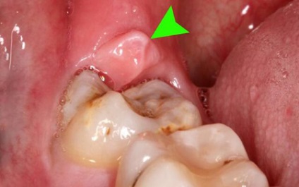 Pe dintele de înțelepciune, inflamația capotei, tratamentul, îndepărtarea