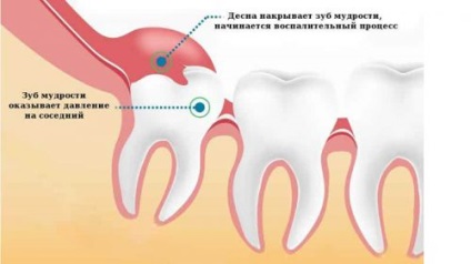 Pe dintele de înțelepciune, inflamația capotei, tratamentul, îndepărtarea