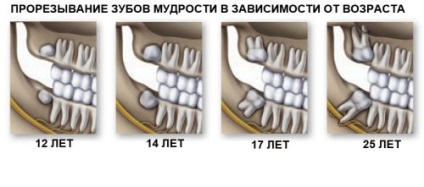 Pe dintele de înțelepciune, inflamația capotei, tratamentul, îndepărtarea