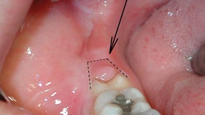 Pe dintele de înțelepciune, inflamația capotei, tratamentul, îndepărtarea